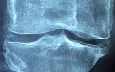Osteoarthritis